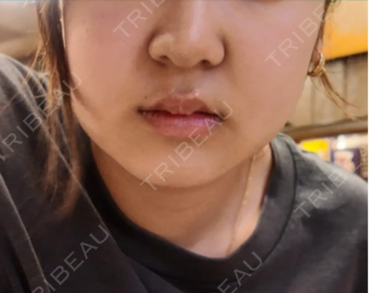 施術前の写真