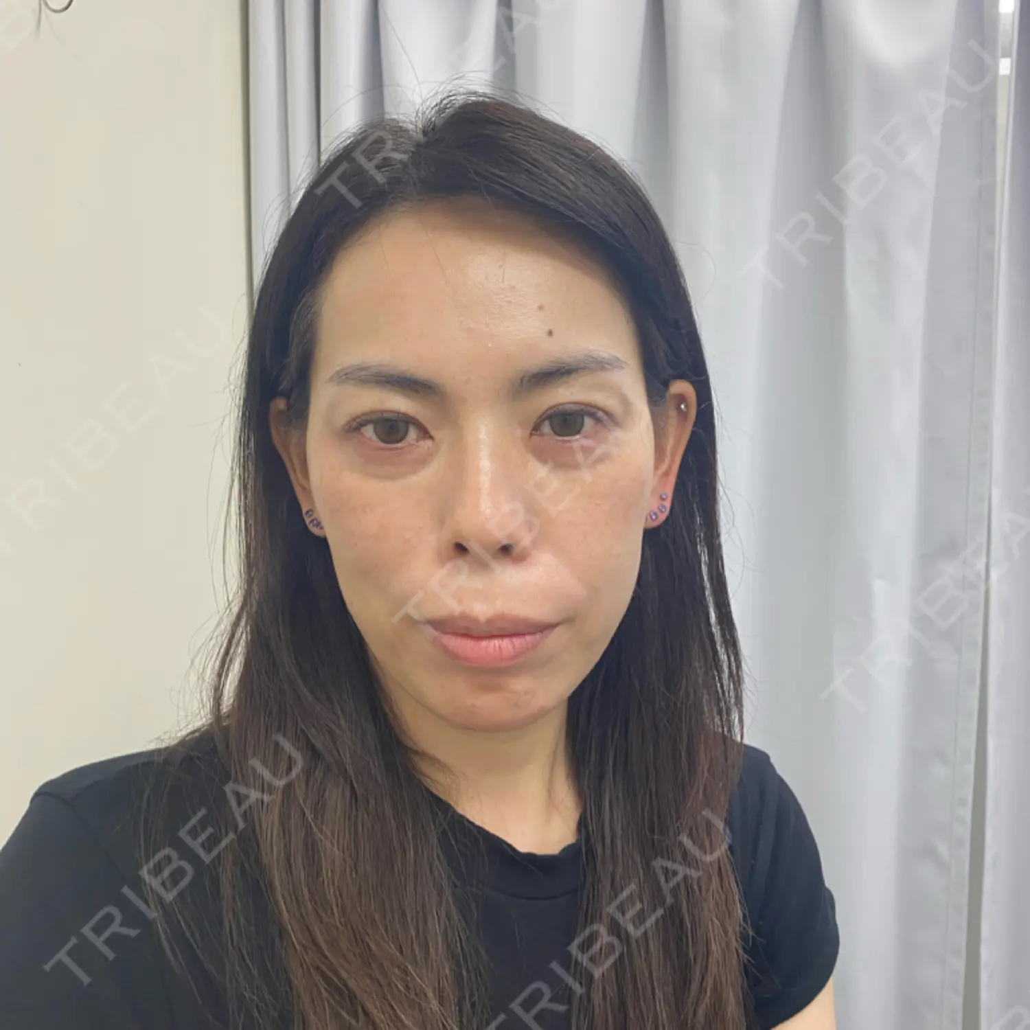 施術前の写真