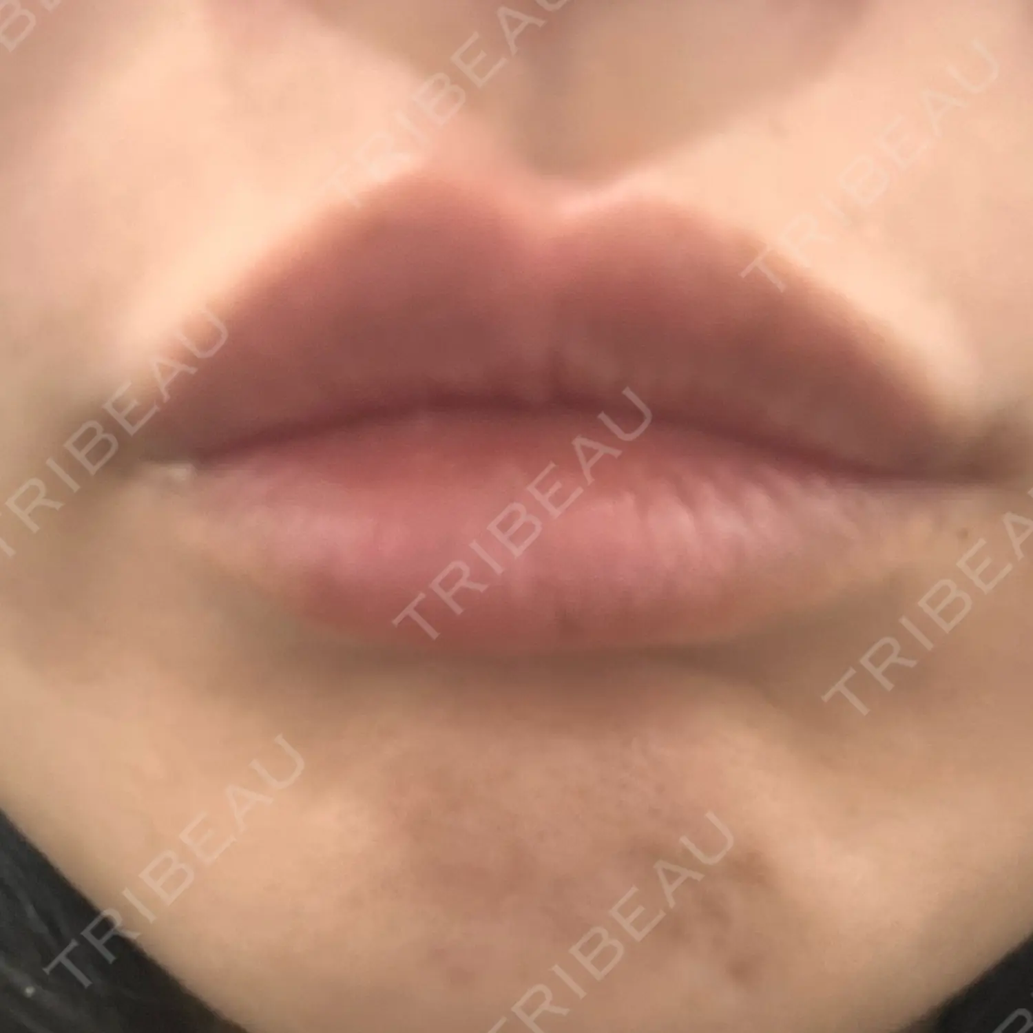 施術前の写真