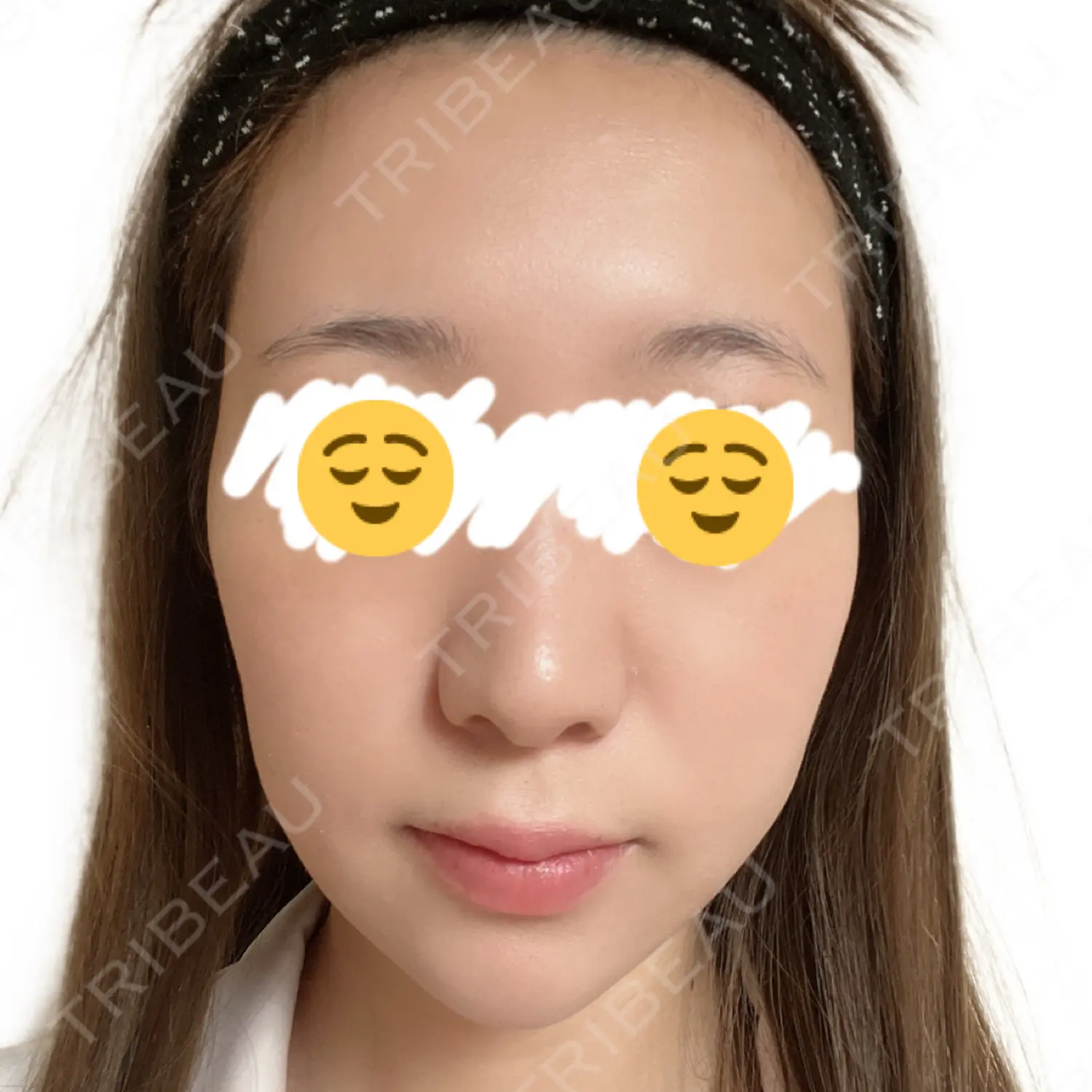 施術前の写真