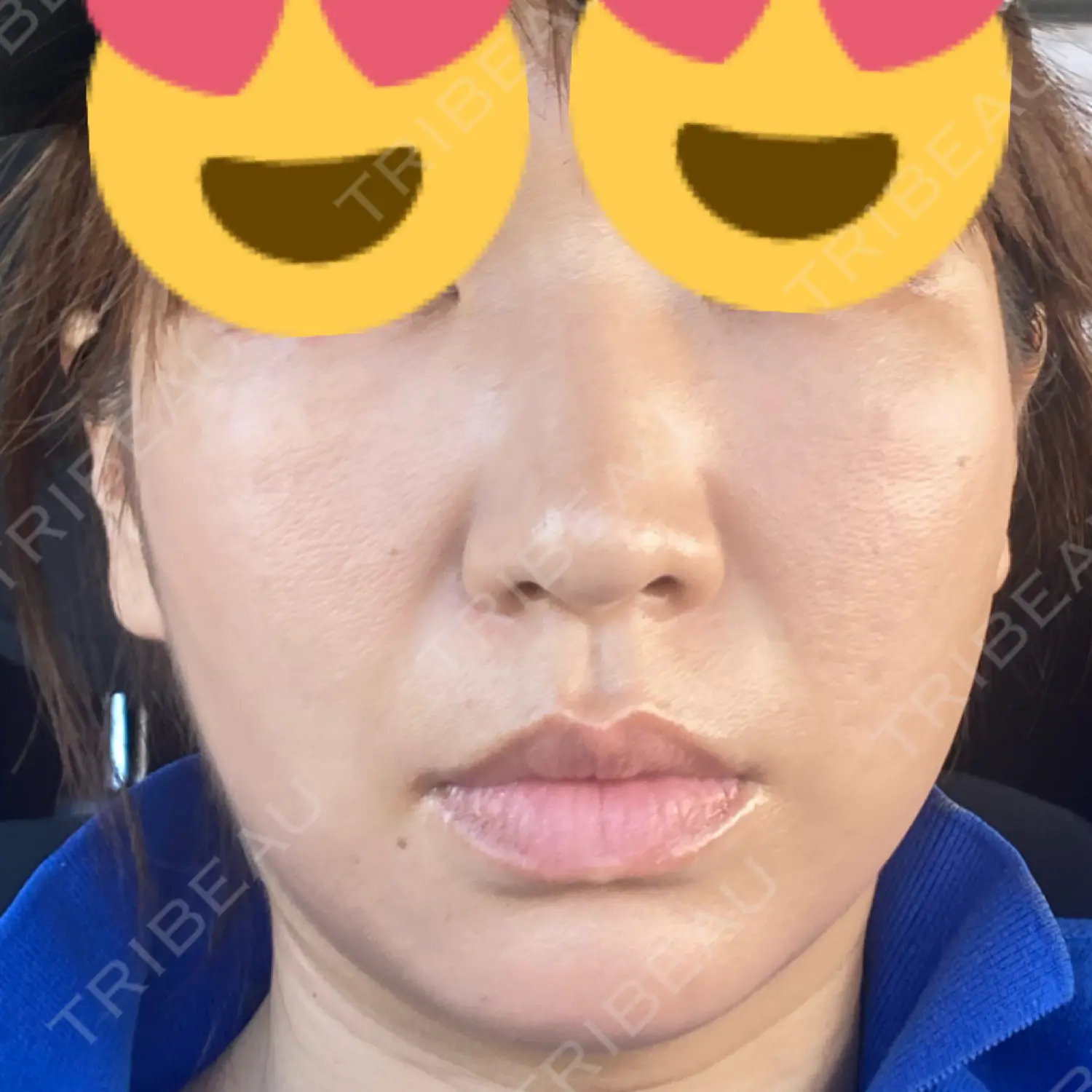 施術前の写真