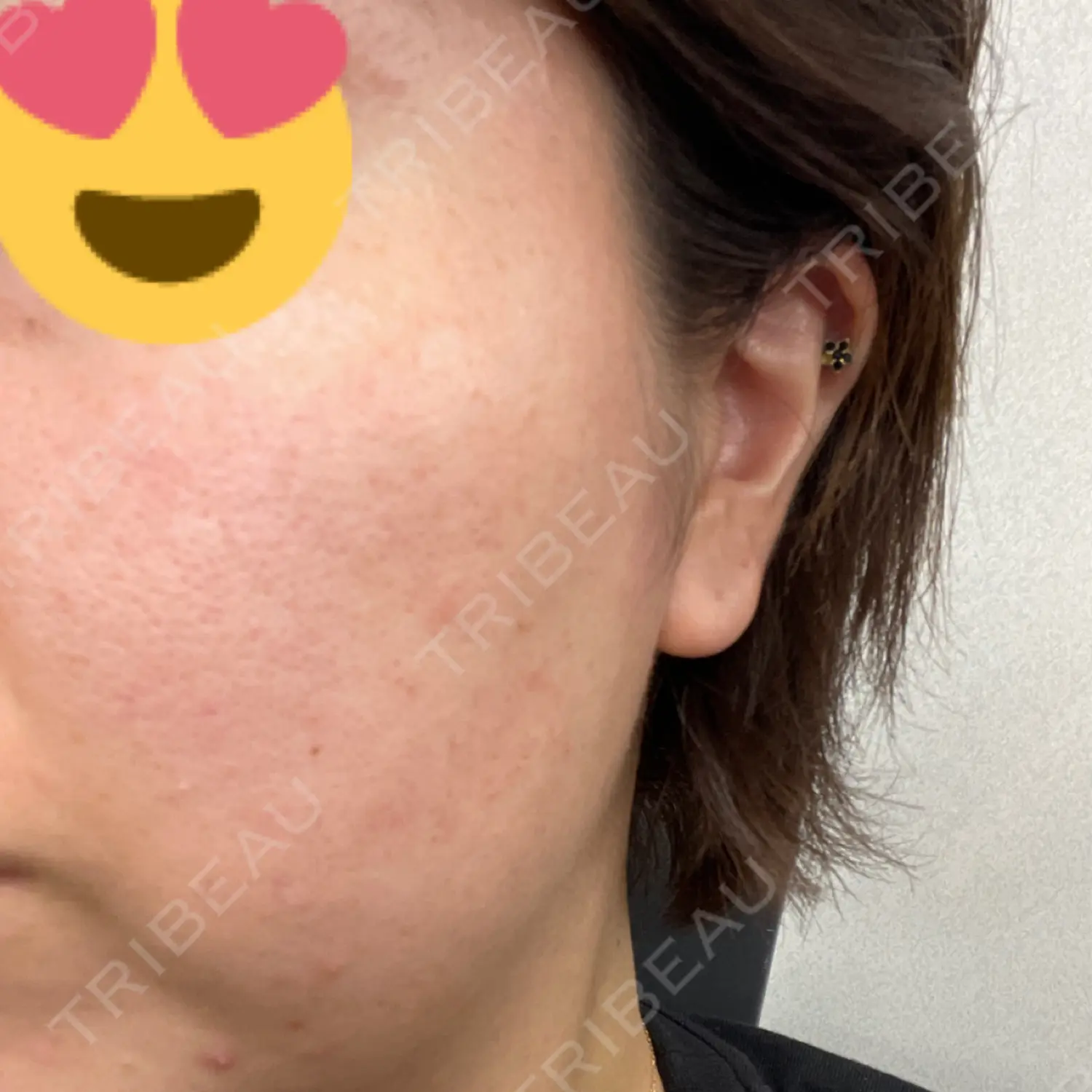 施術前の写真