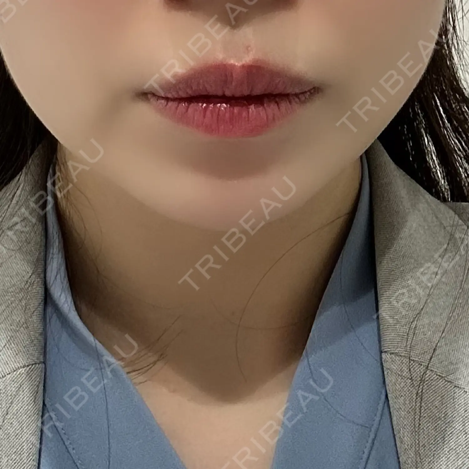 施術前の写真