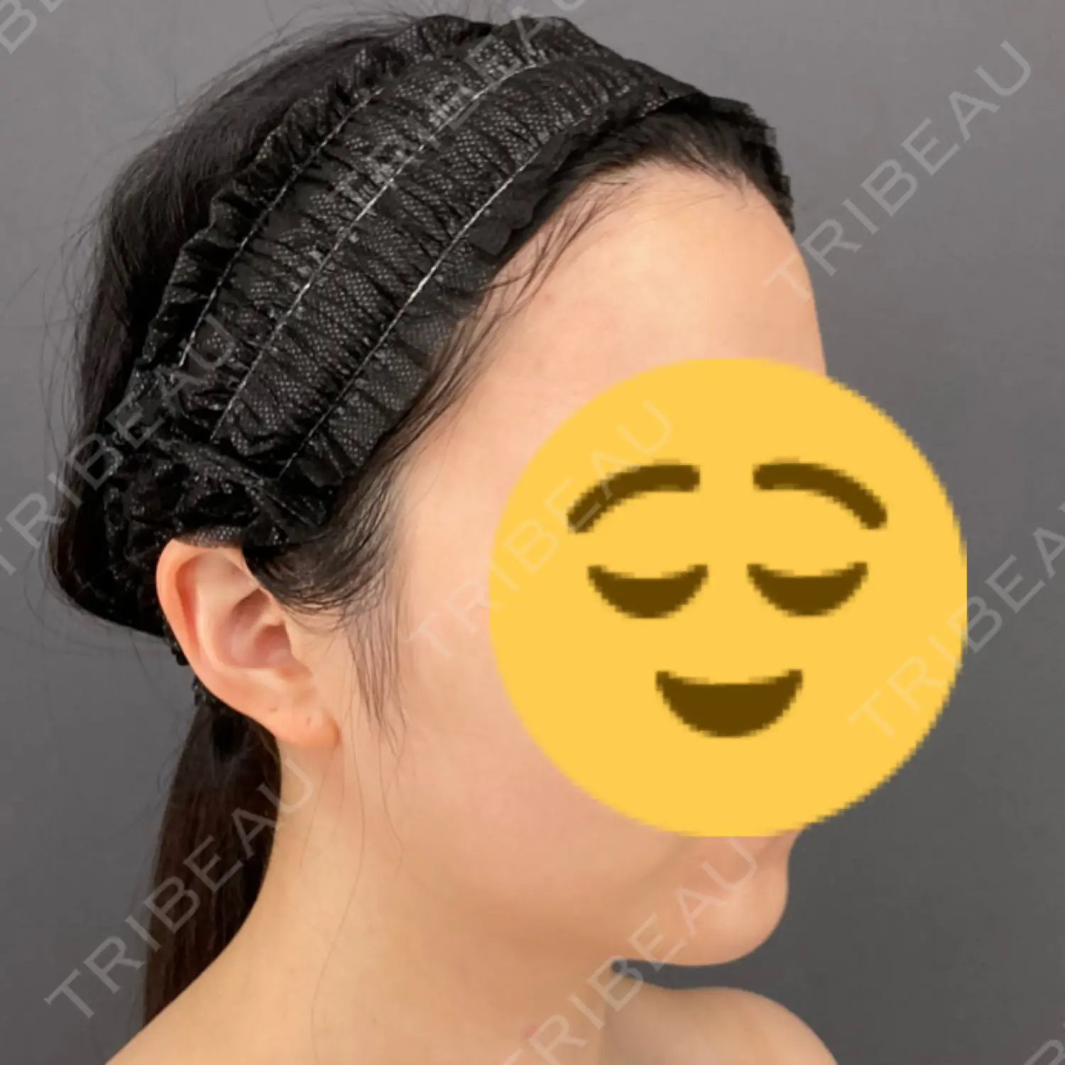 施術前の写真