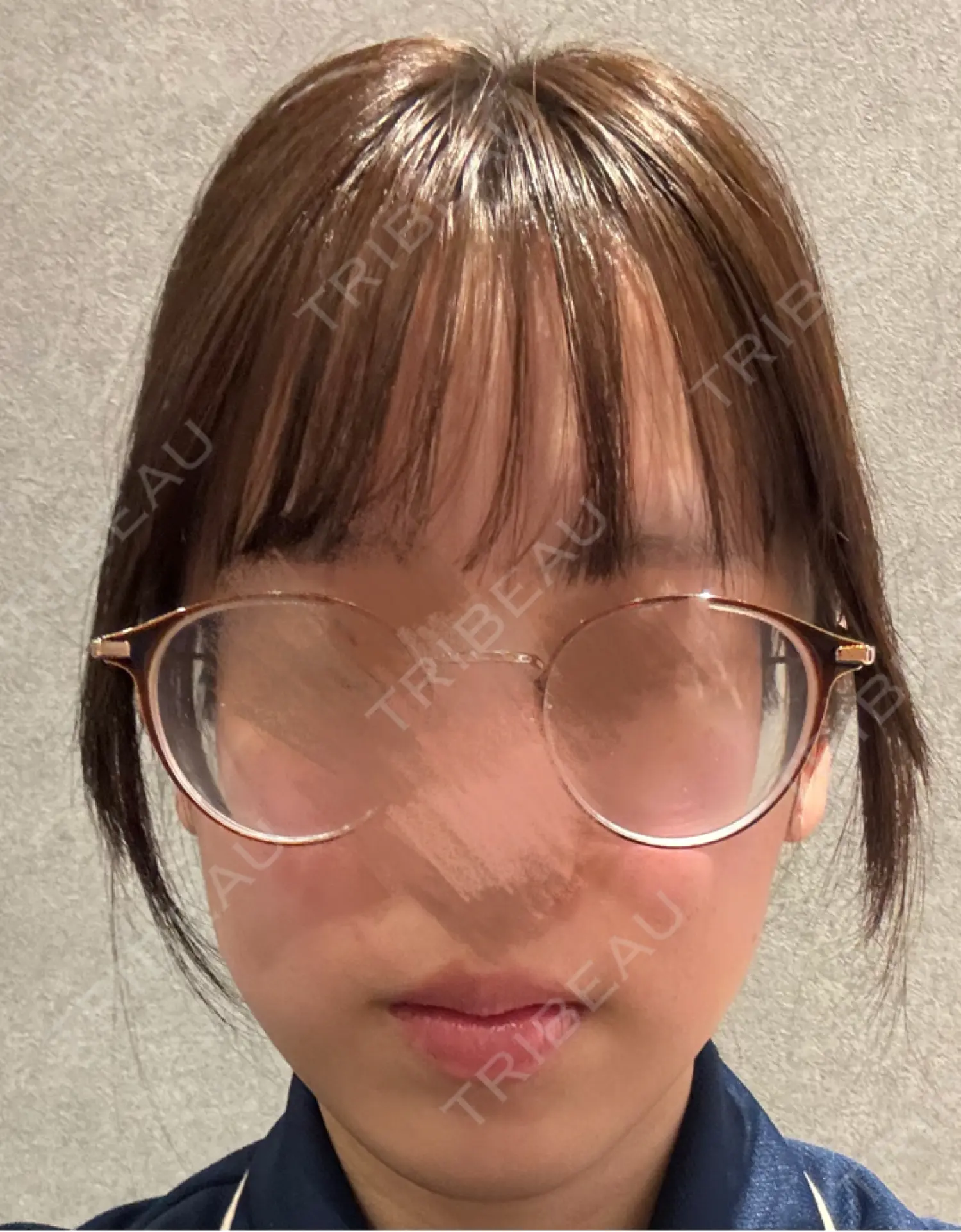 施術前の写真