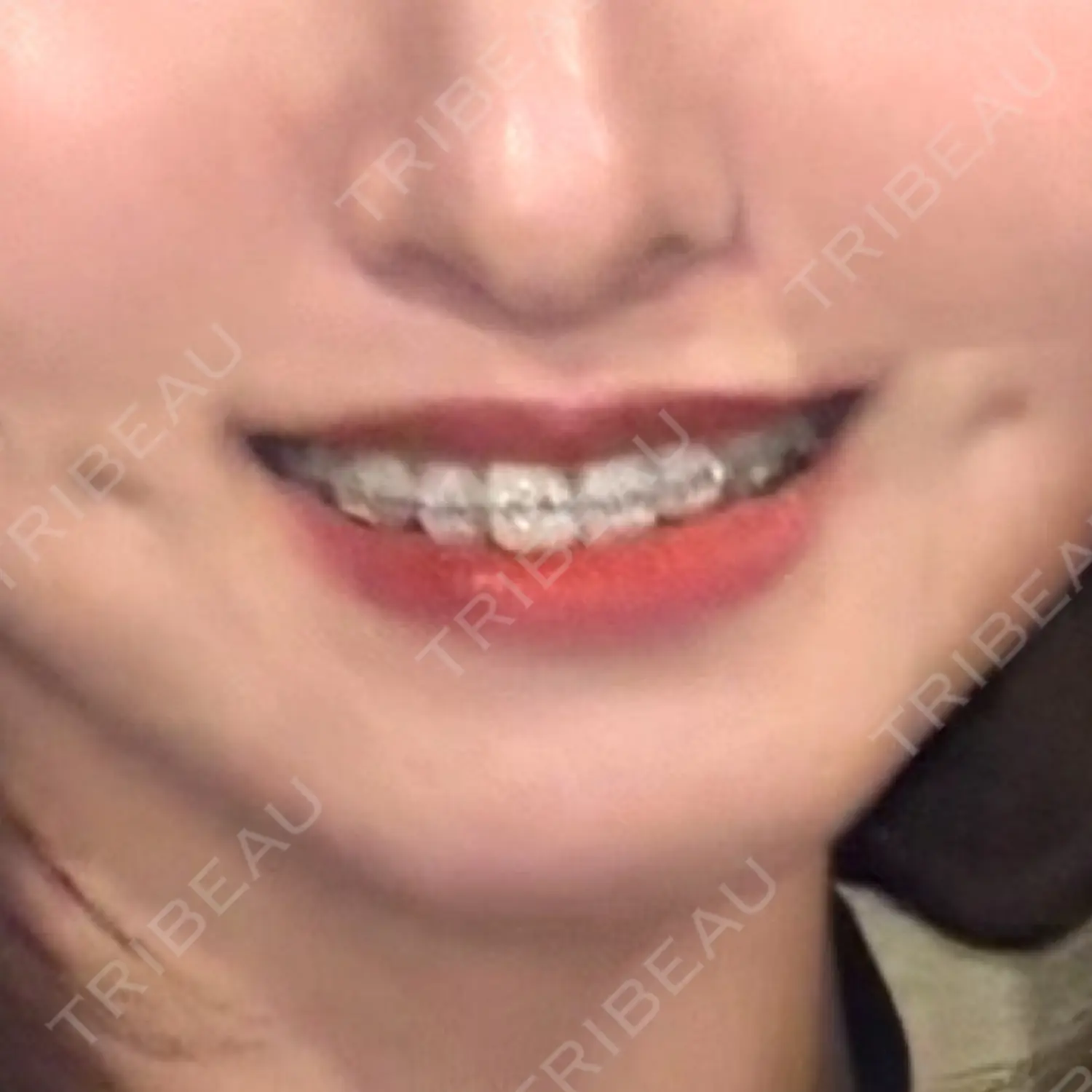 施術前の写真