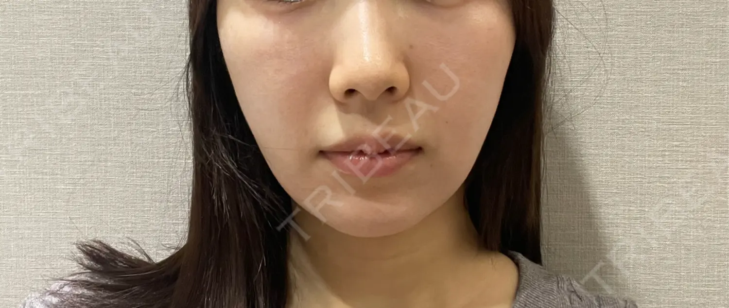 施術前の写真