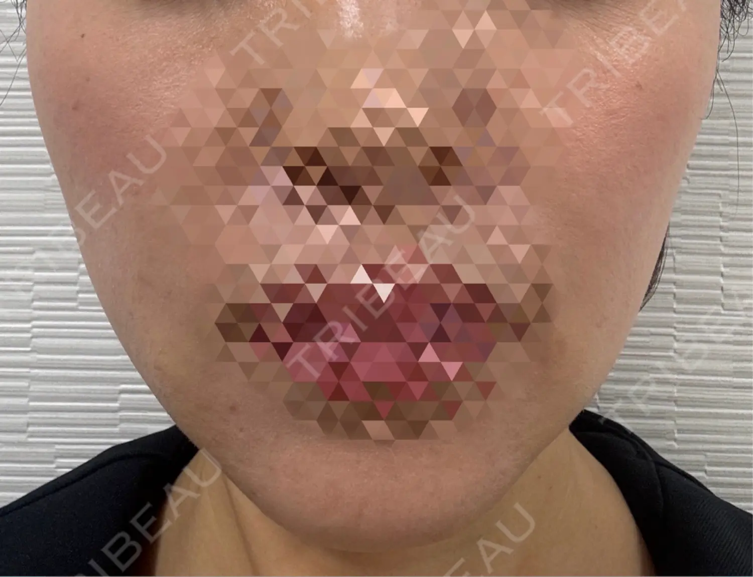 施術前の写真