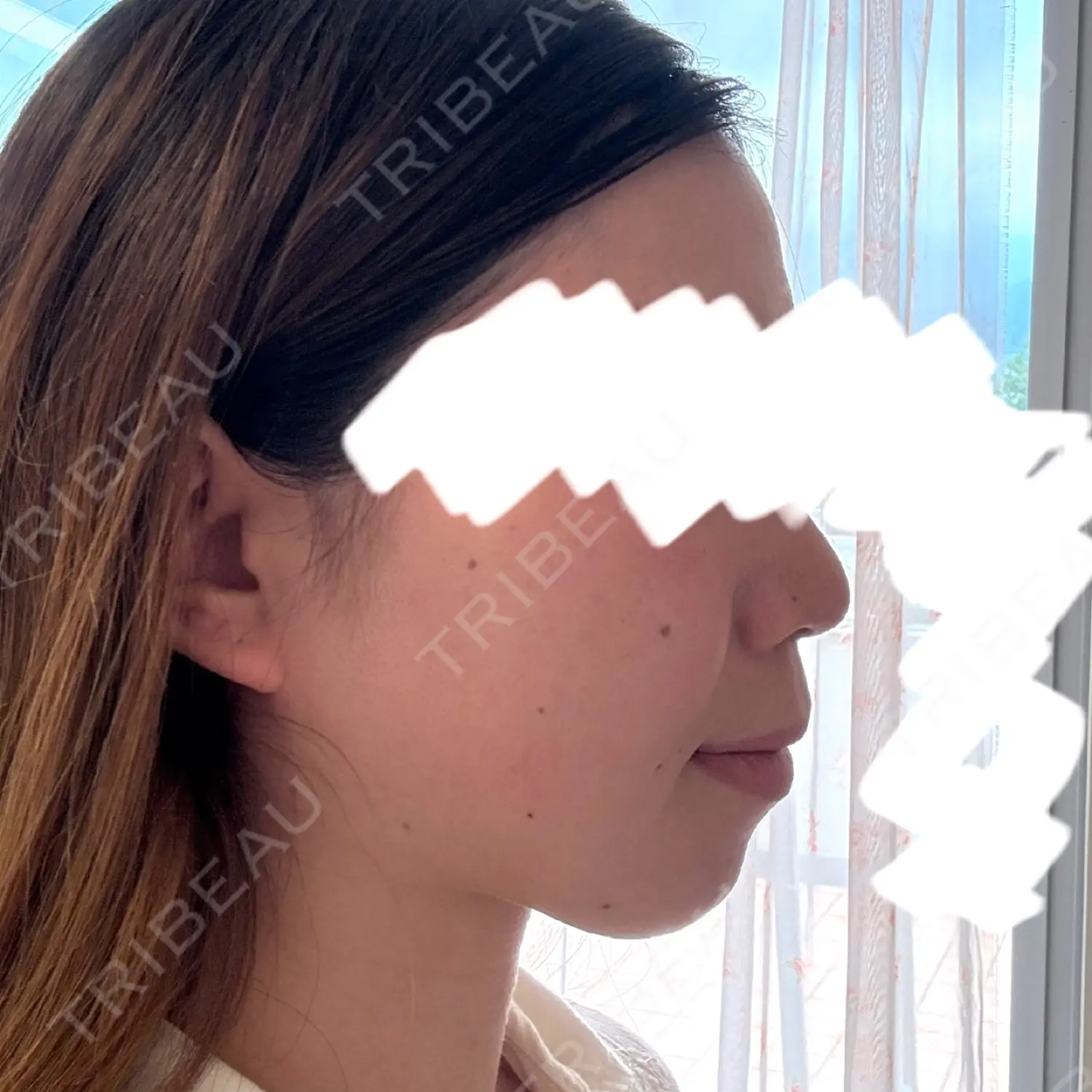 施術前の写真