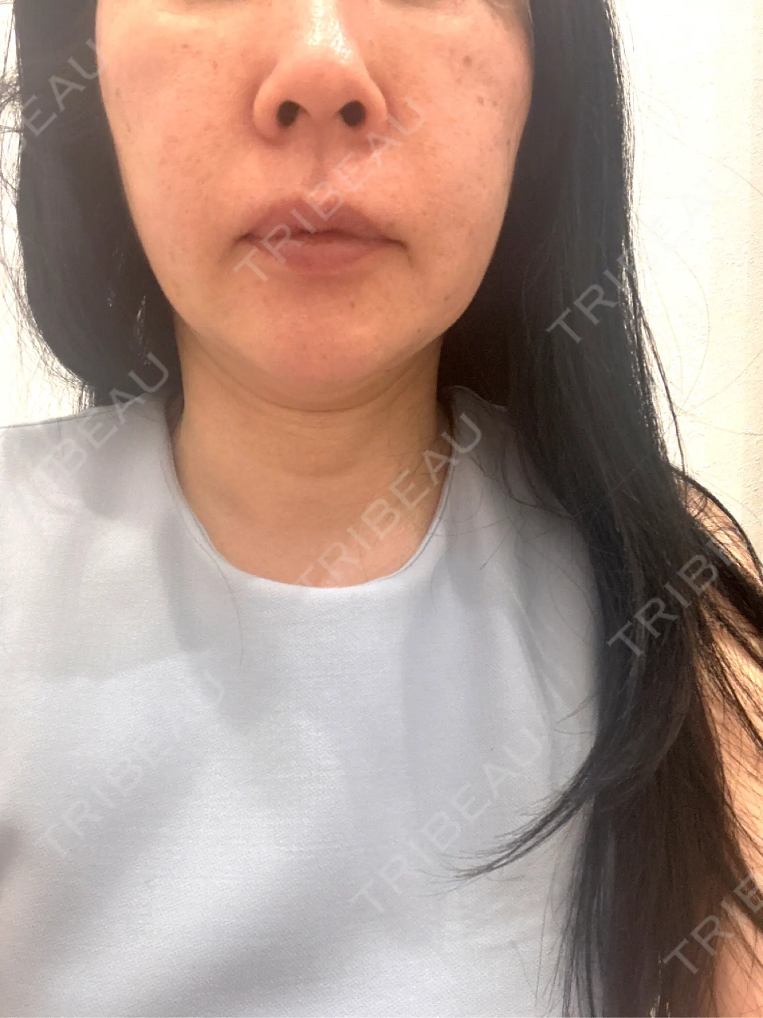 施術前の写真