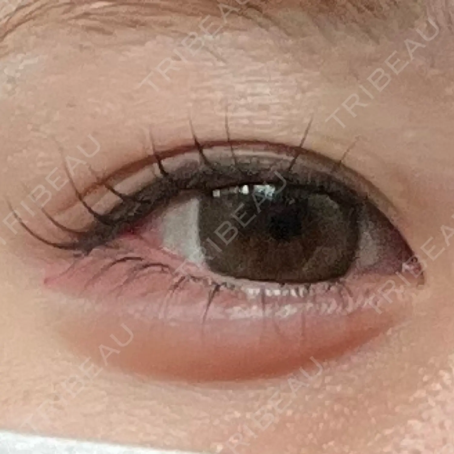 施術前の写真