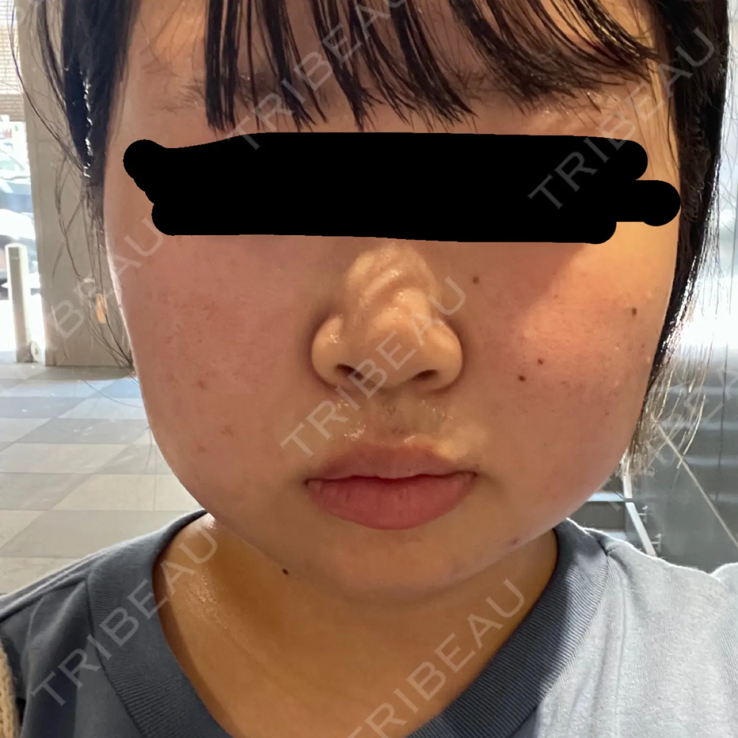 施術前の写真