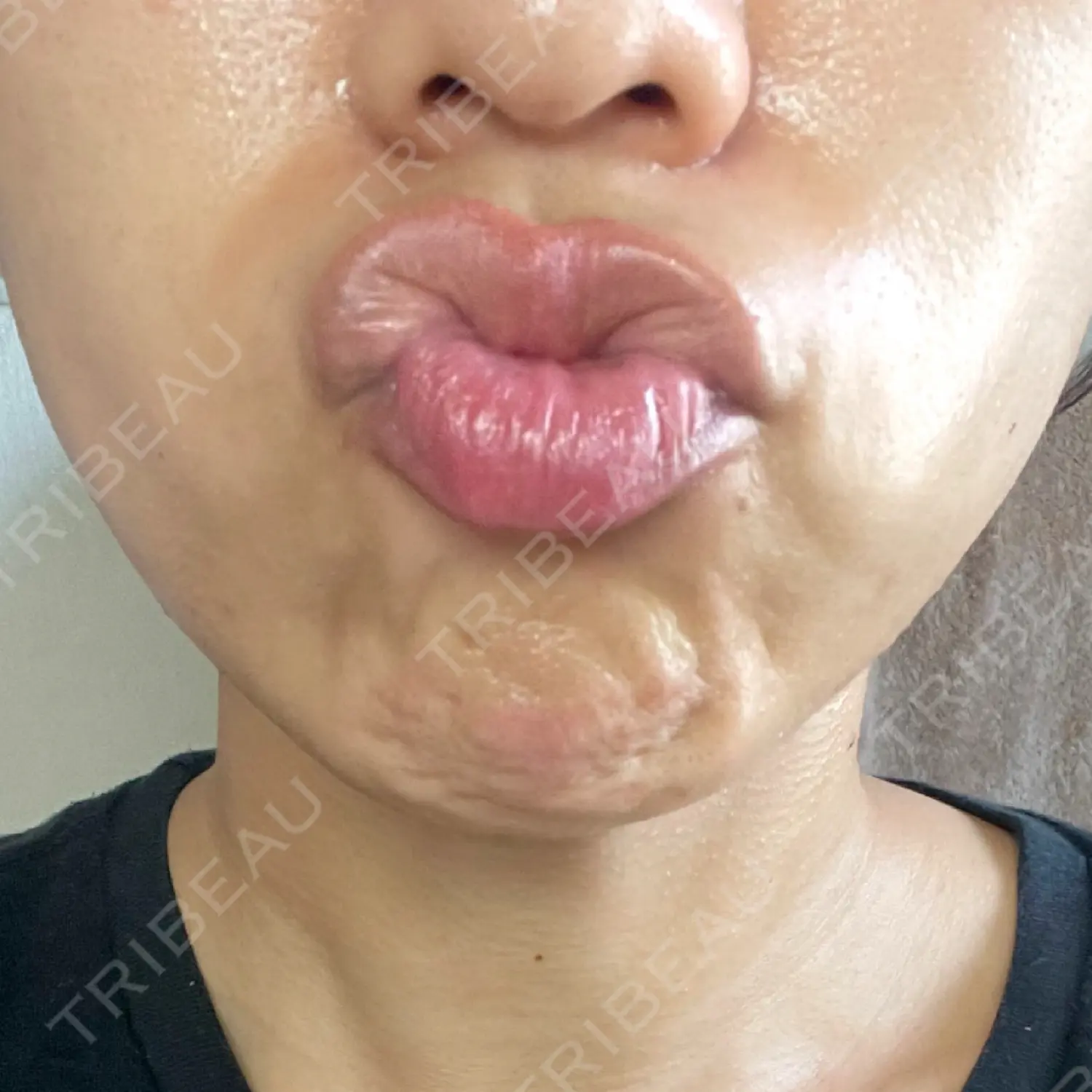 施術前の写真