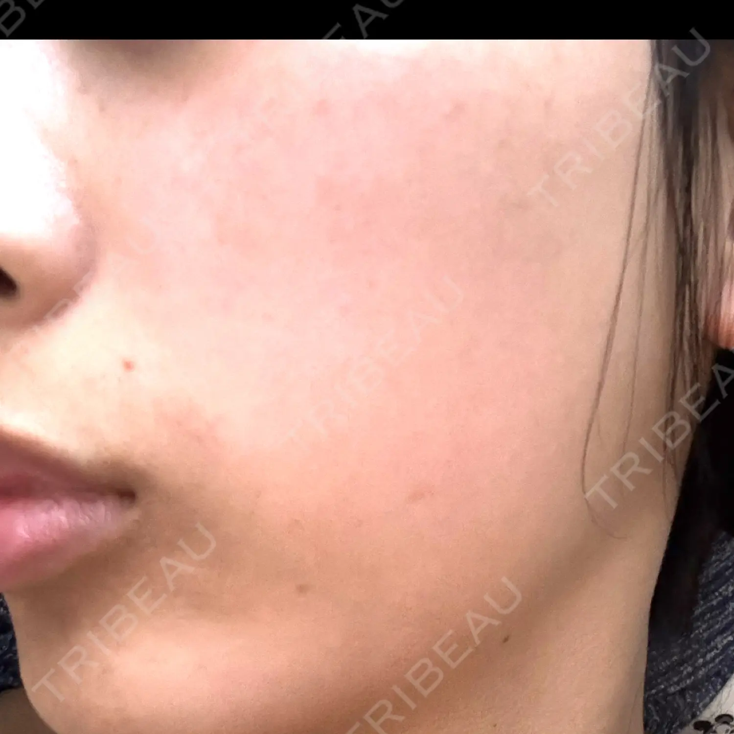 施術前の写真