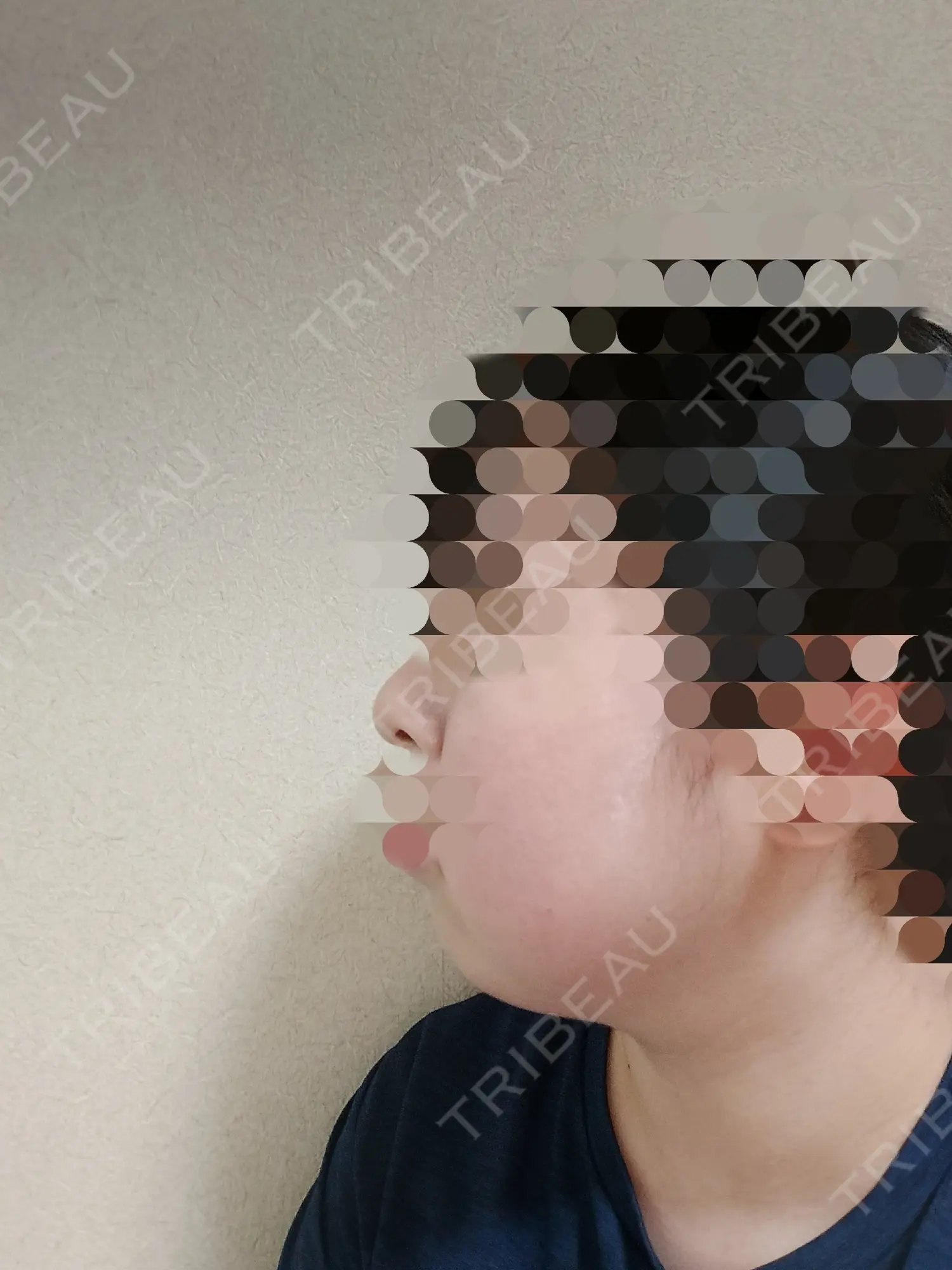 施術前の写真