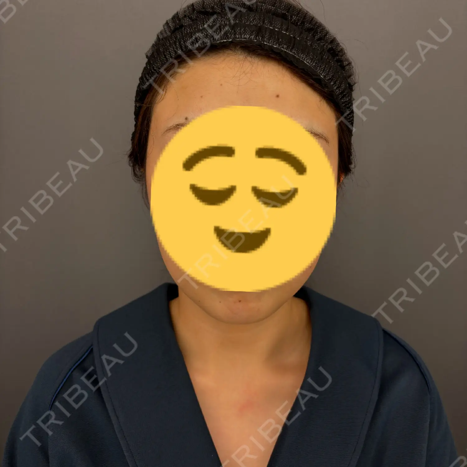 施術前の写真