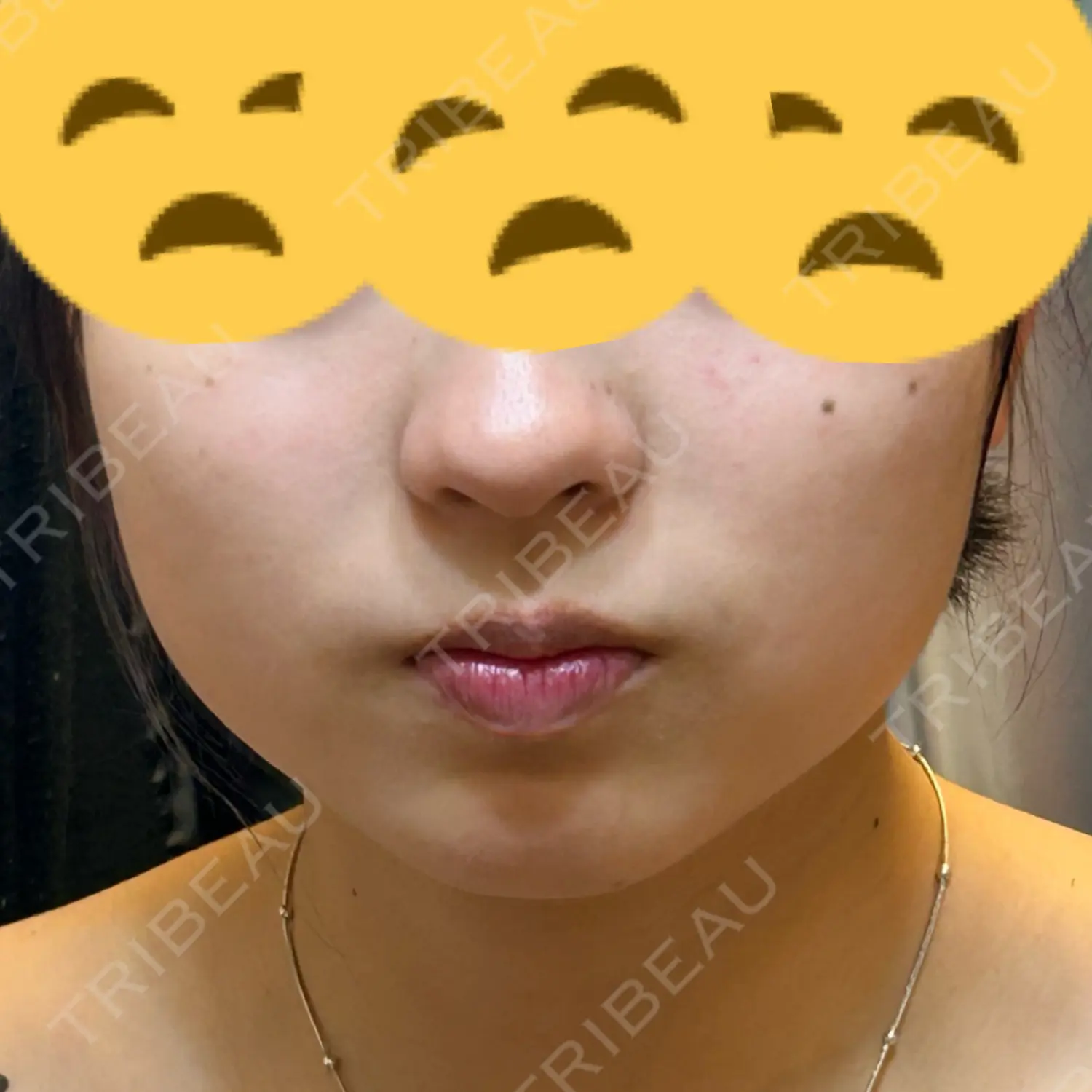 施術前の写真