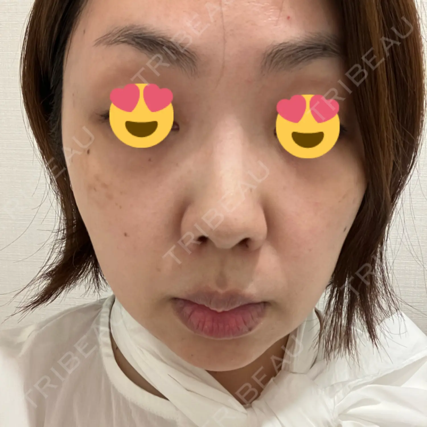 施術前の写真