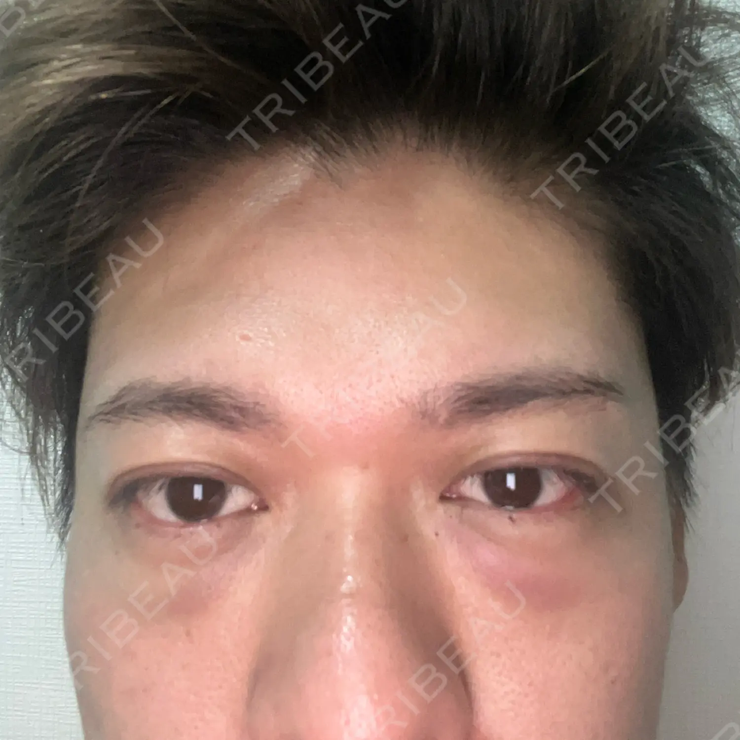 施術前の写真