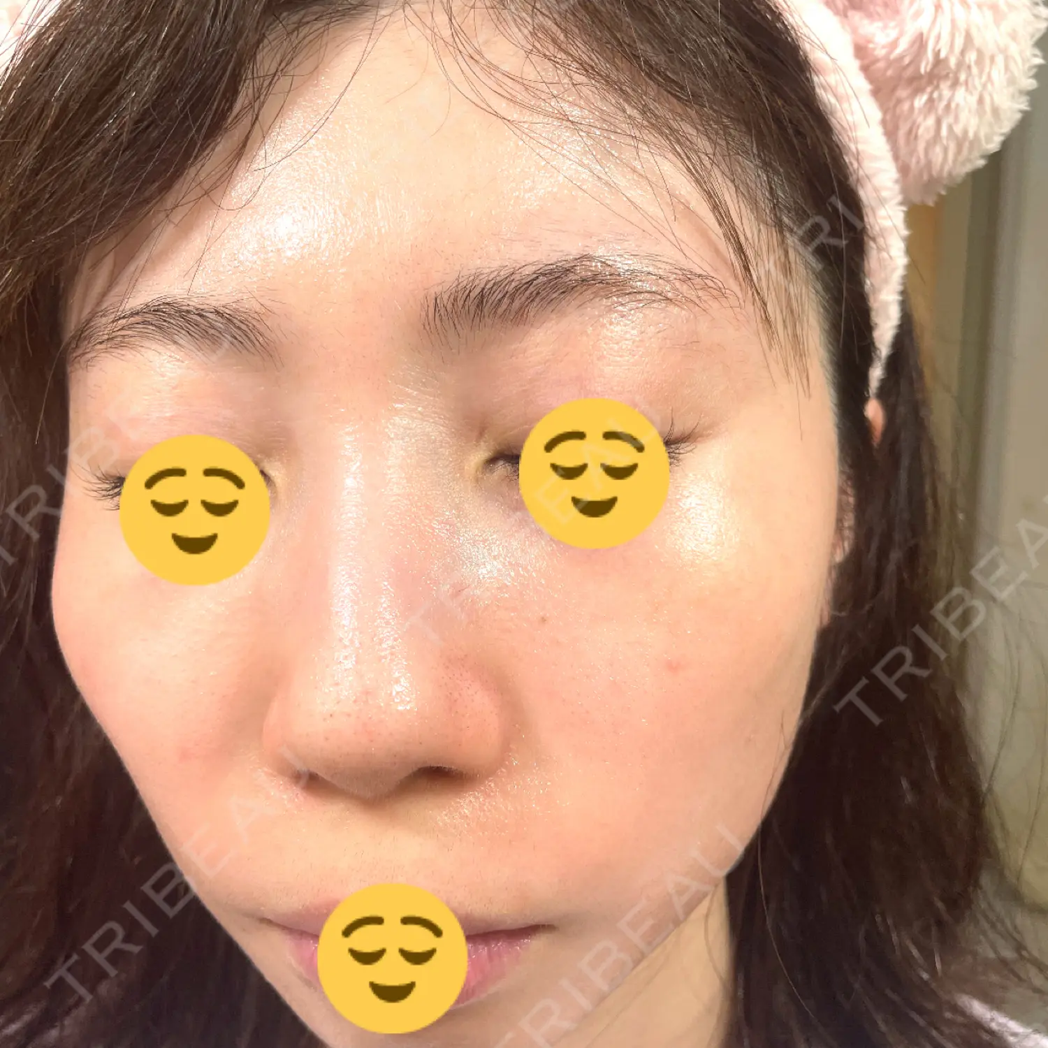 施術前の写真