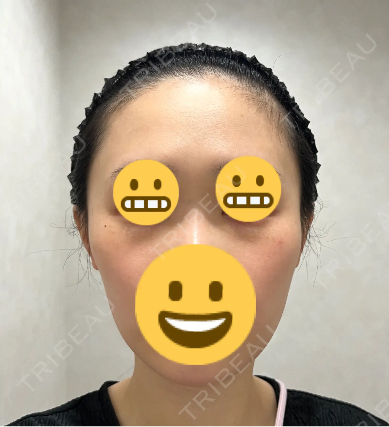 施術前の写真