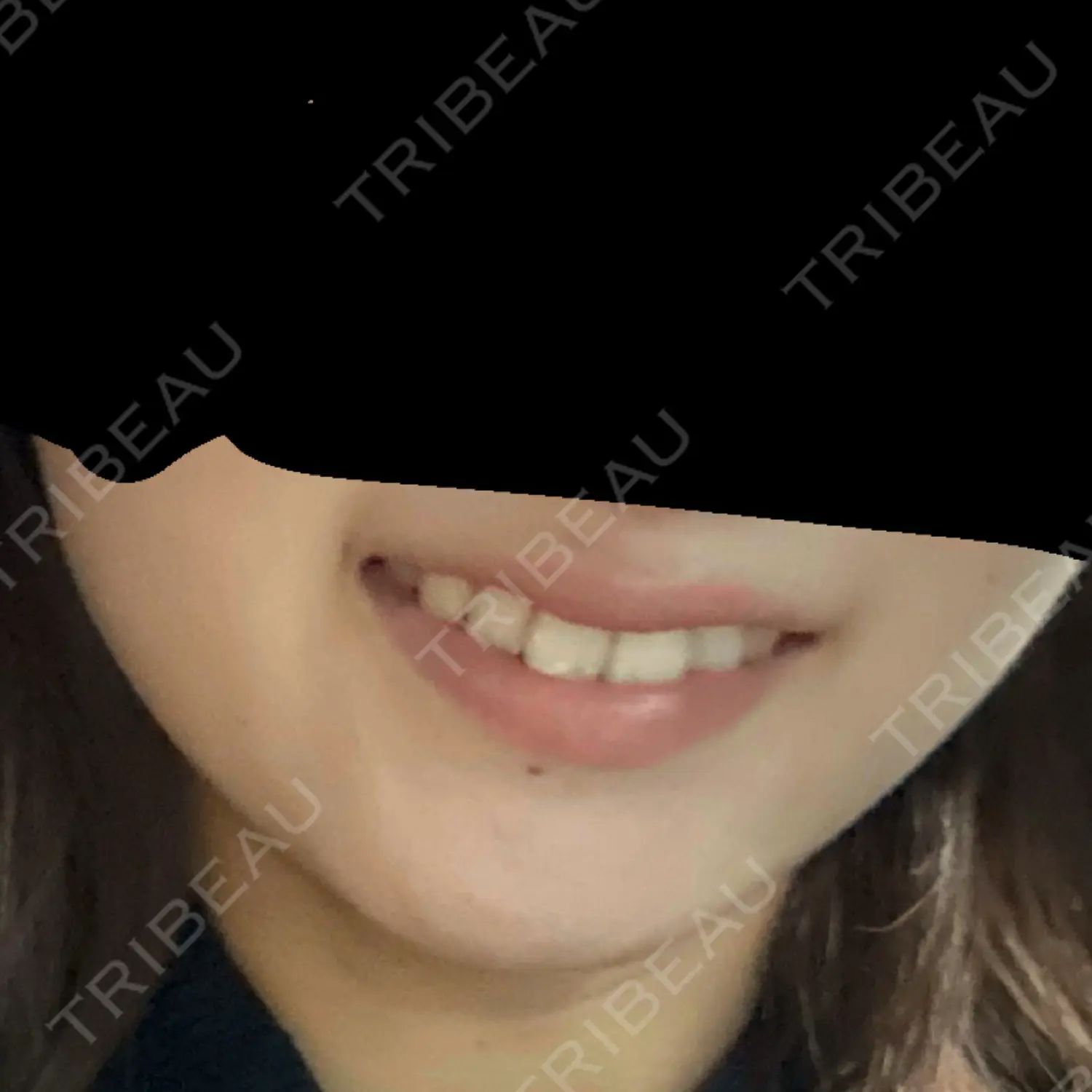 施術前の写真