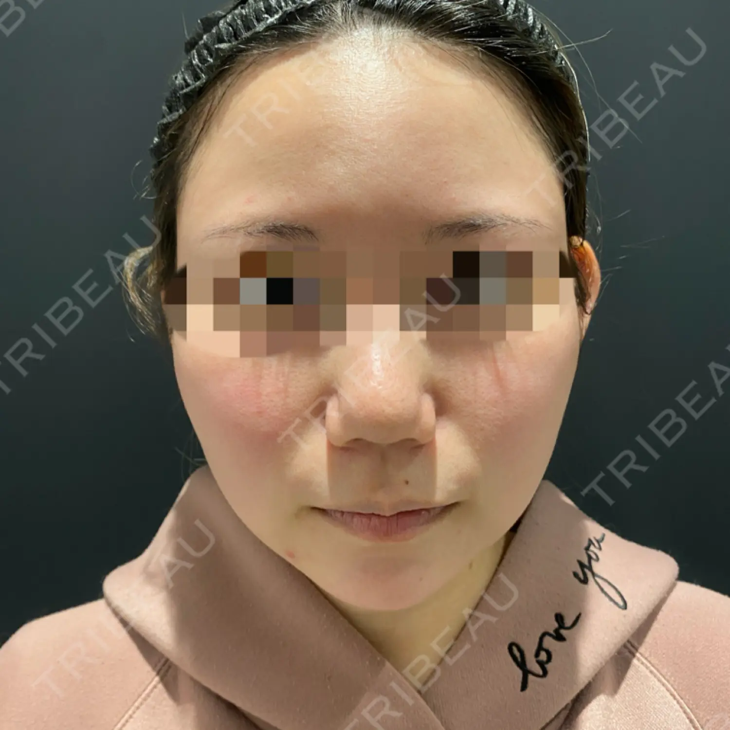 施術前の写真