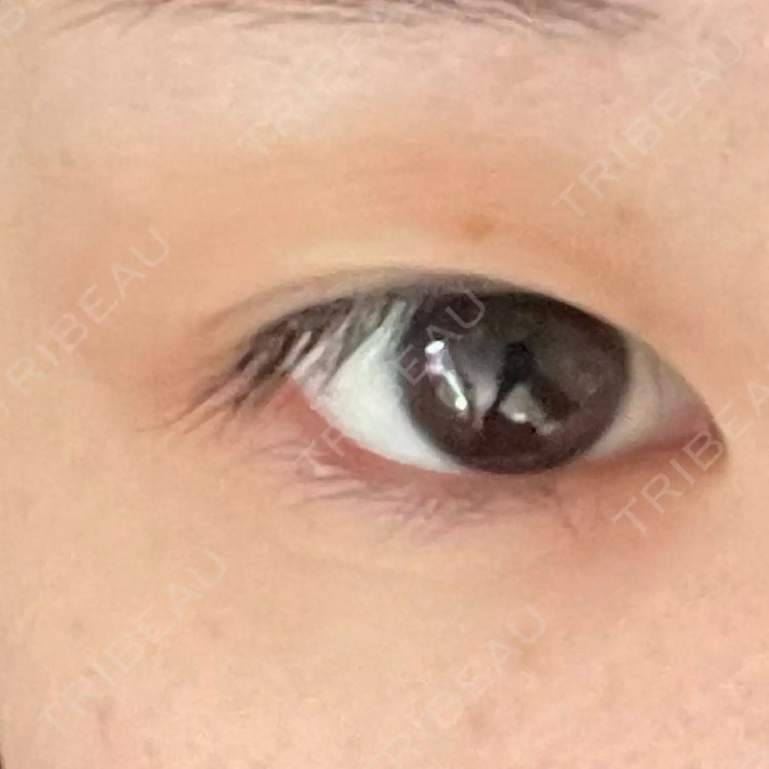 施術前の写真