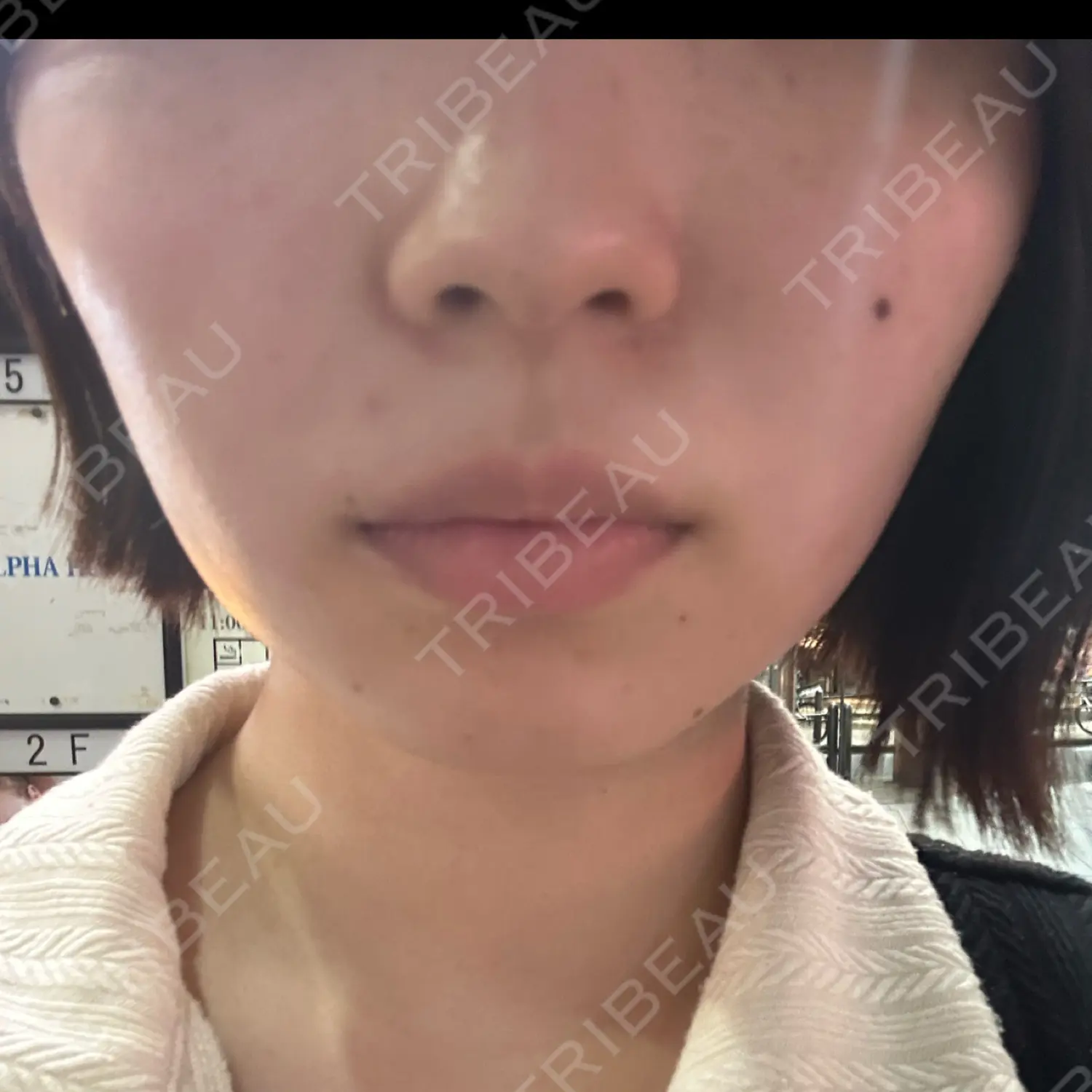 施術前の写真