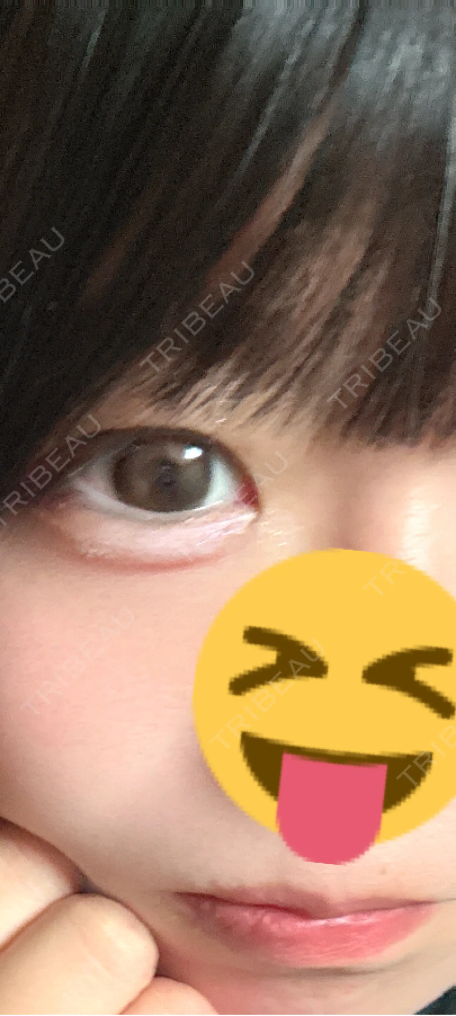 施術前の写真