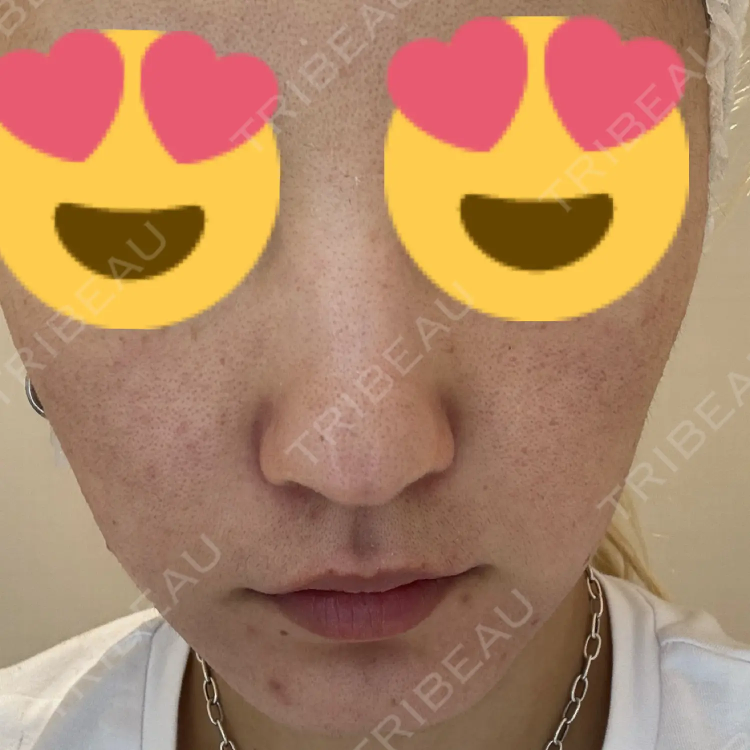 施術前の写真