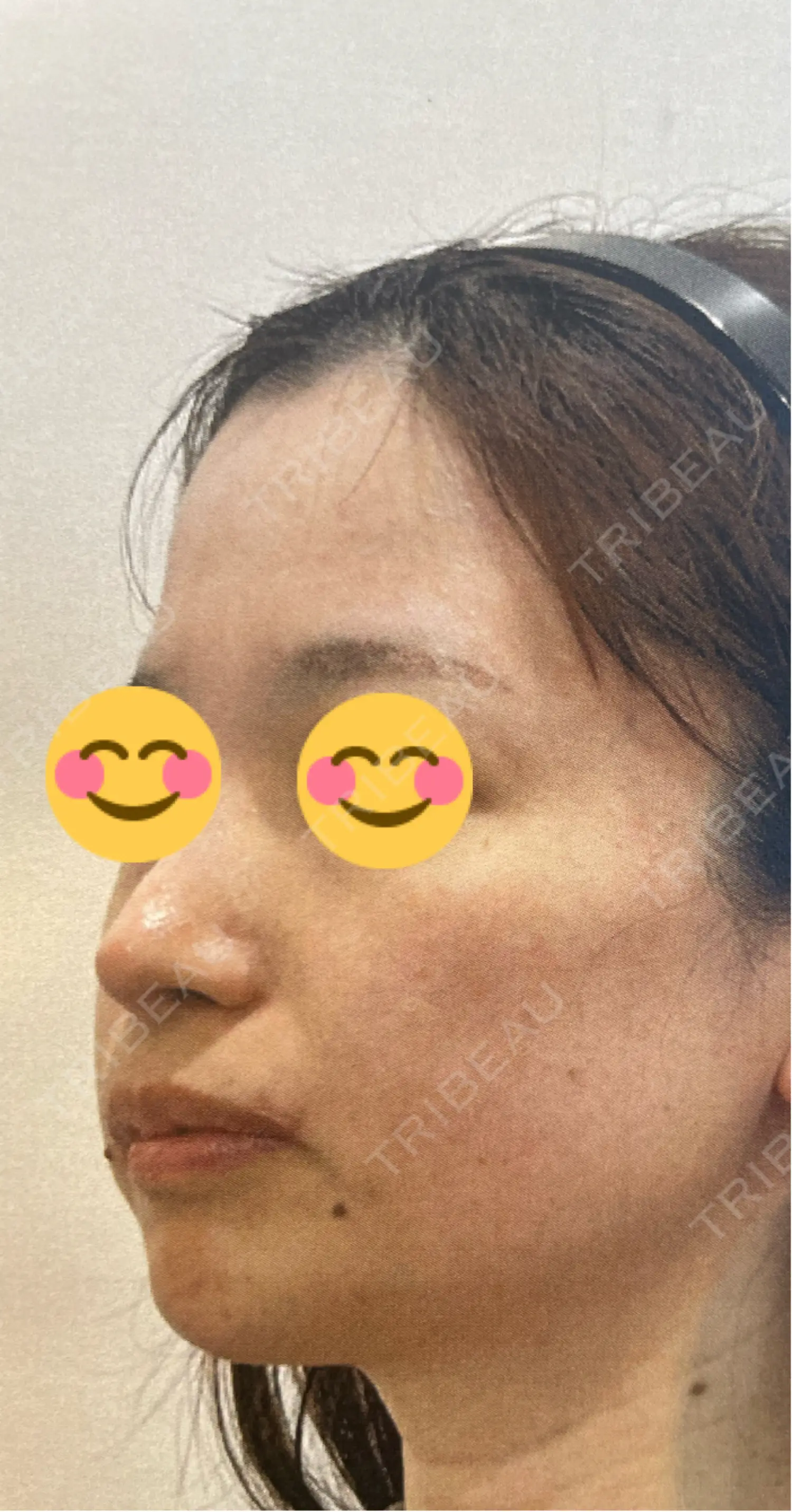 施術前の写真