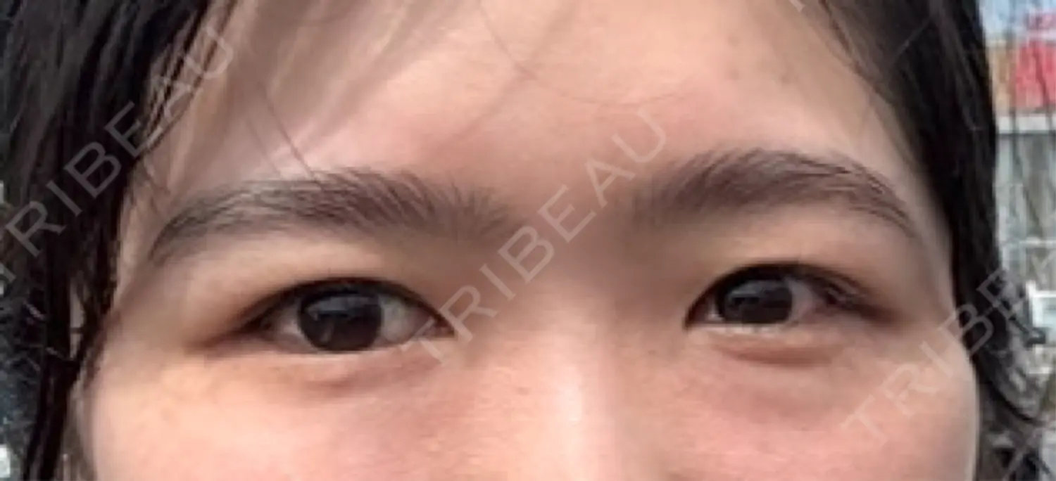 施術前の写真