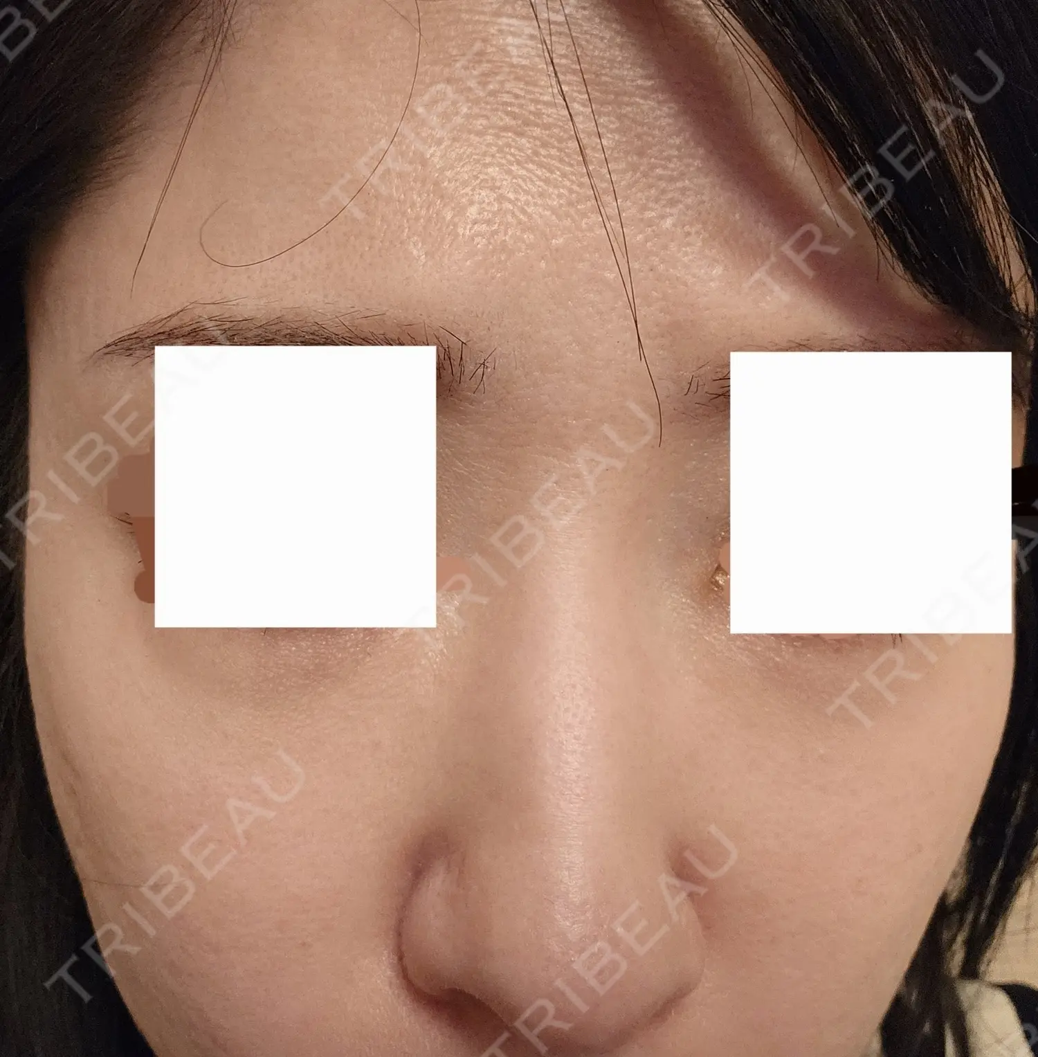 施術前の写真