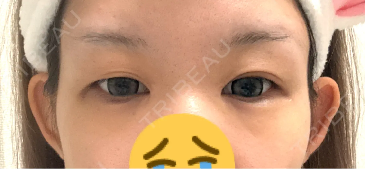 施術前の写真