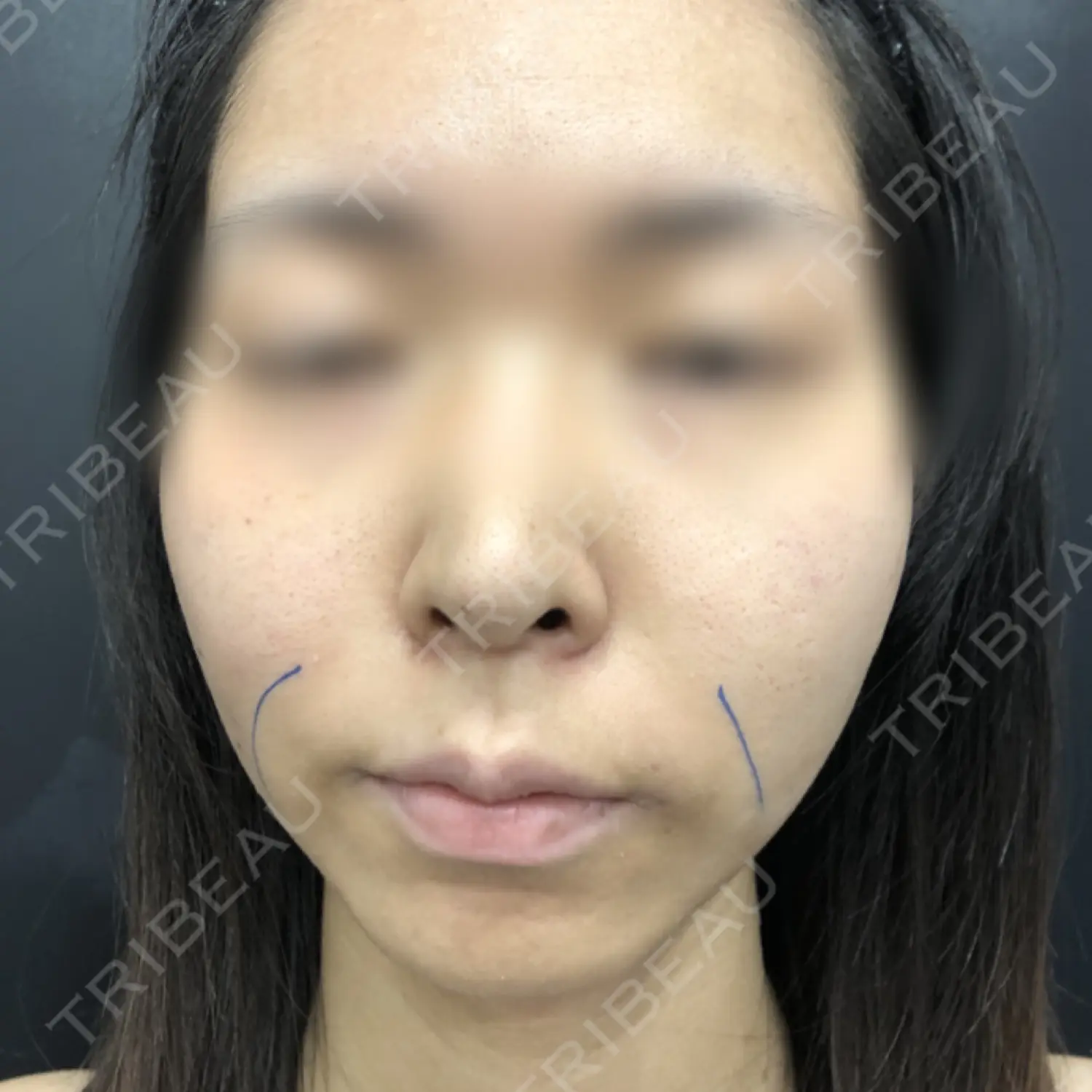施術前の写真