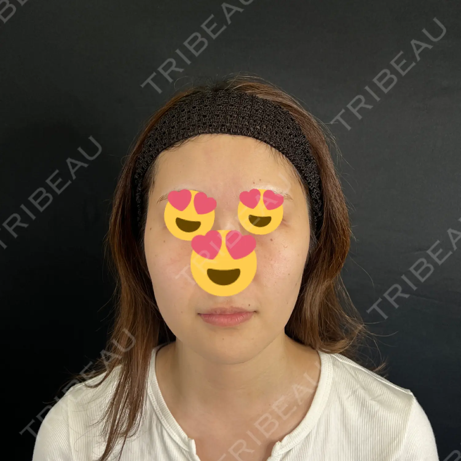 施術前の写真