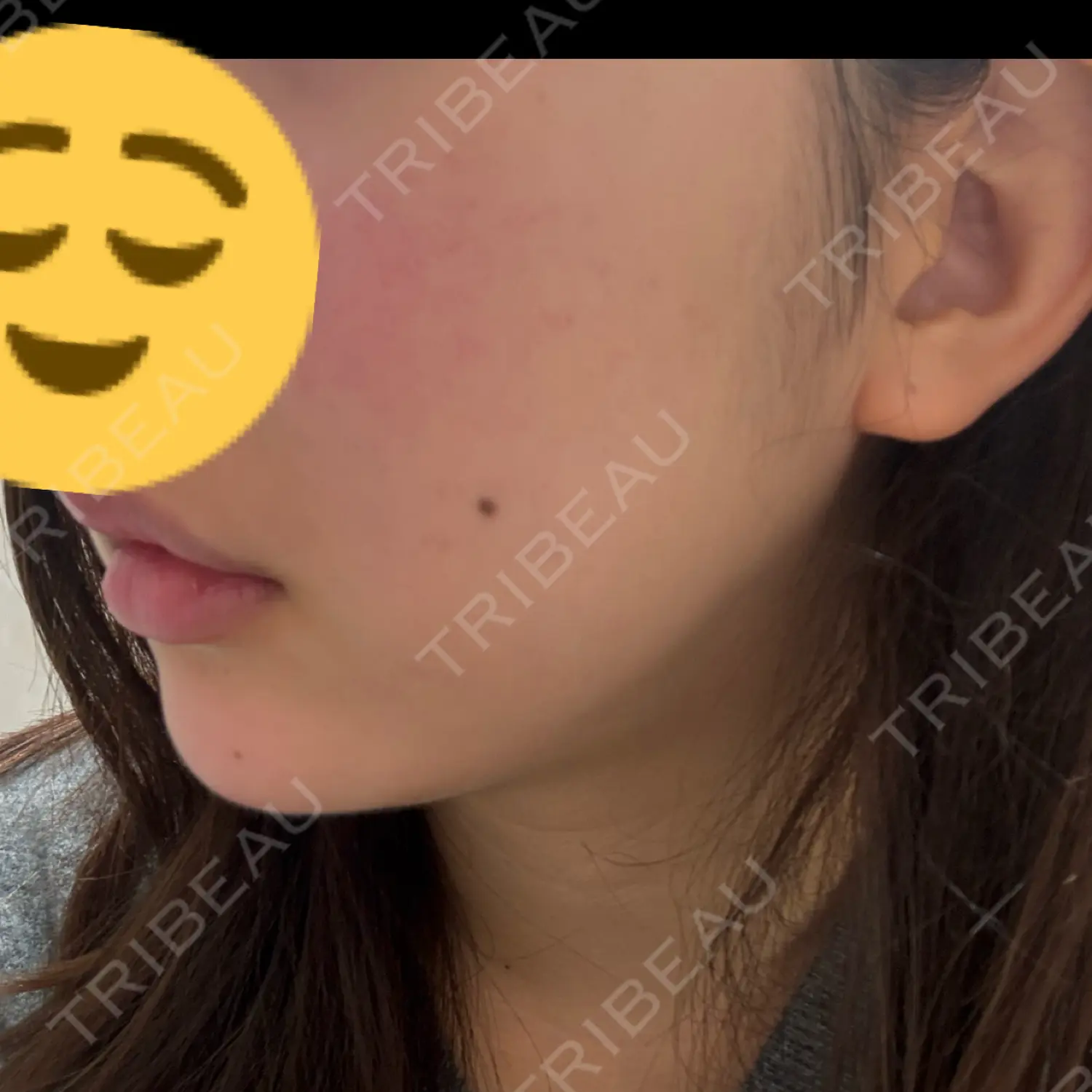 施術前の写真