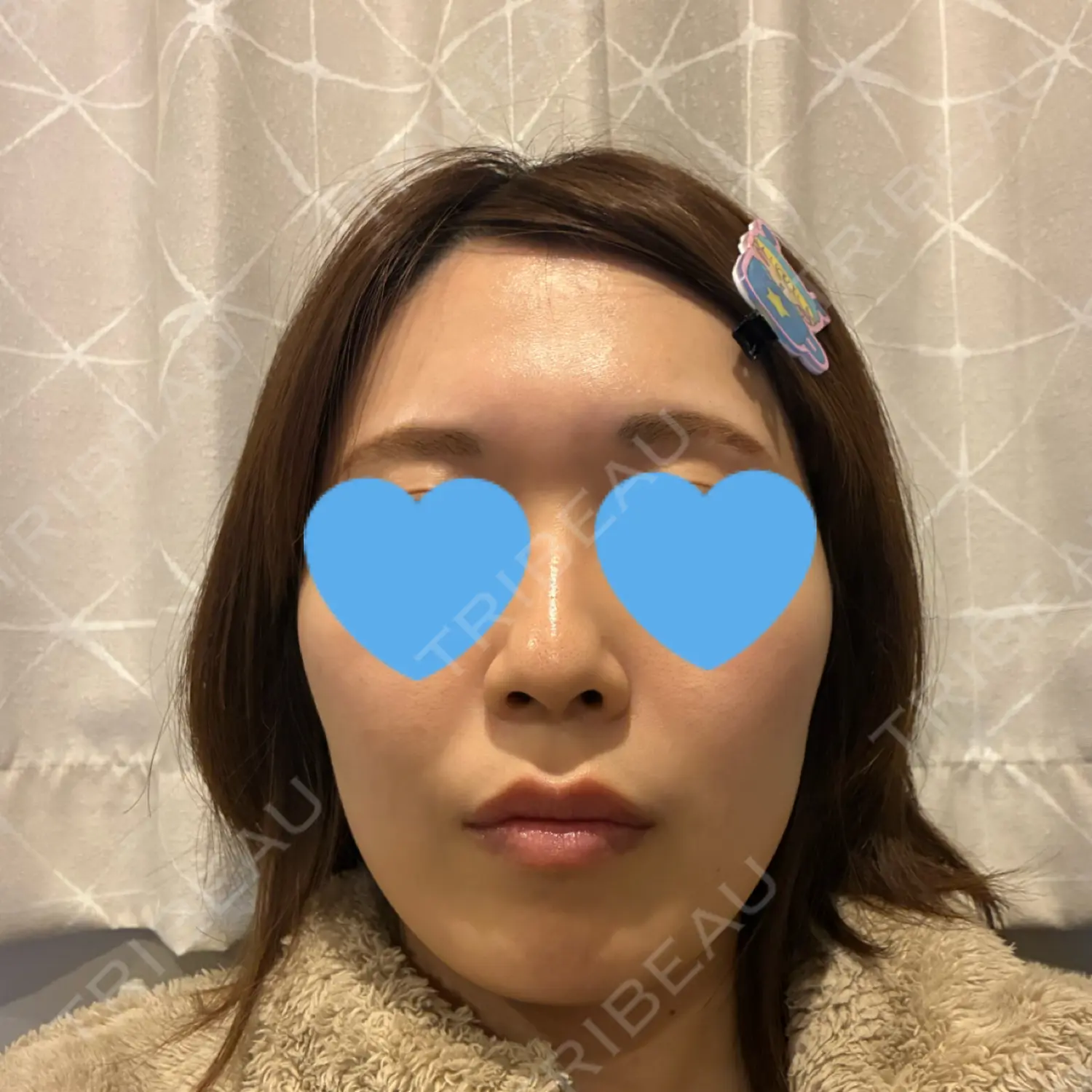 施術前の写真