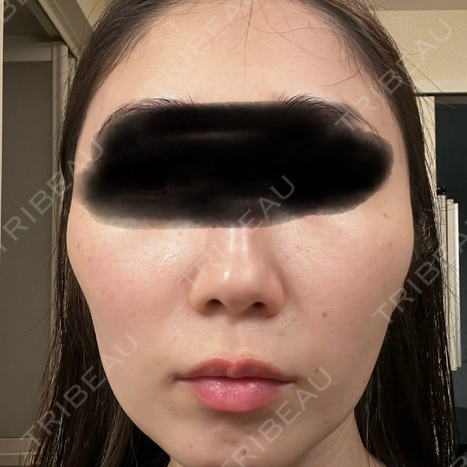 施術前の写真
