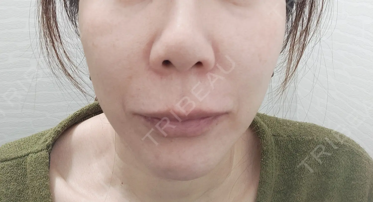 施術前の写真