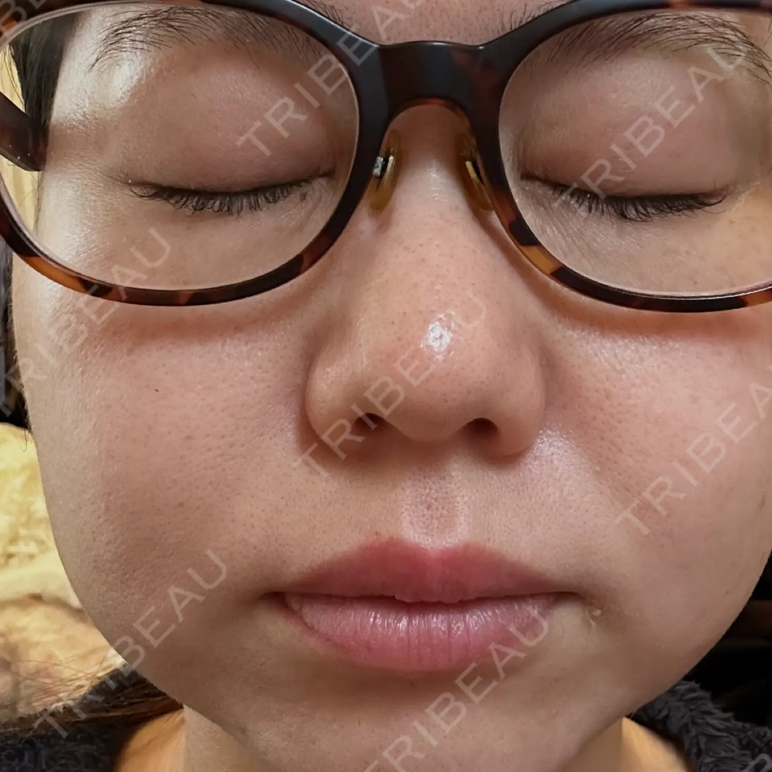 施術前の写真
