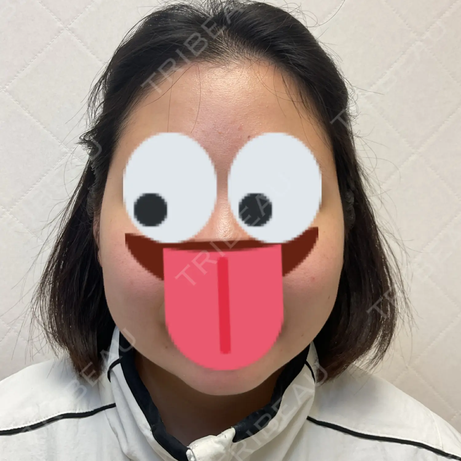 施術前の写真
