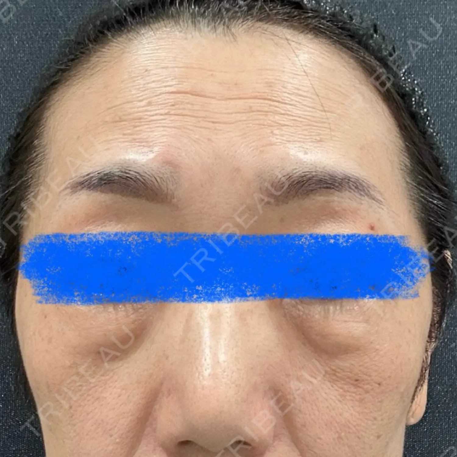 施術前の写真