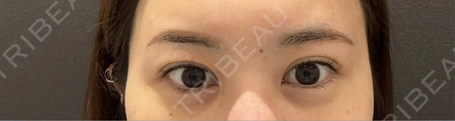 施術前の写真