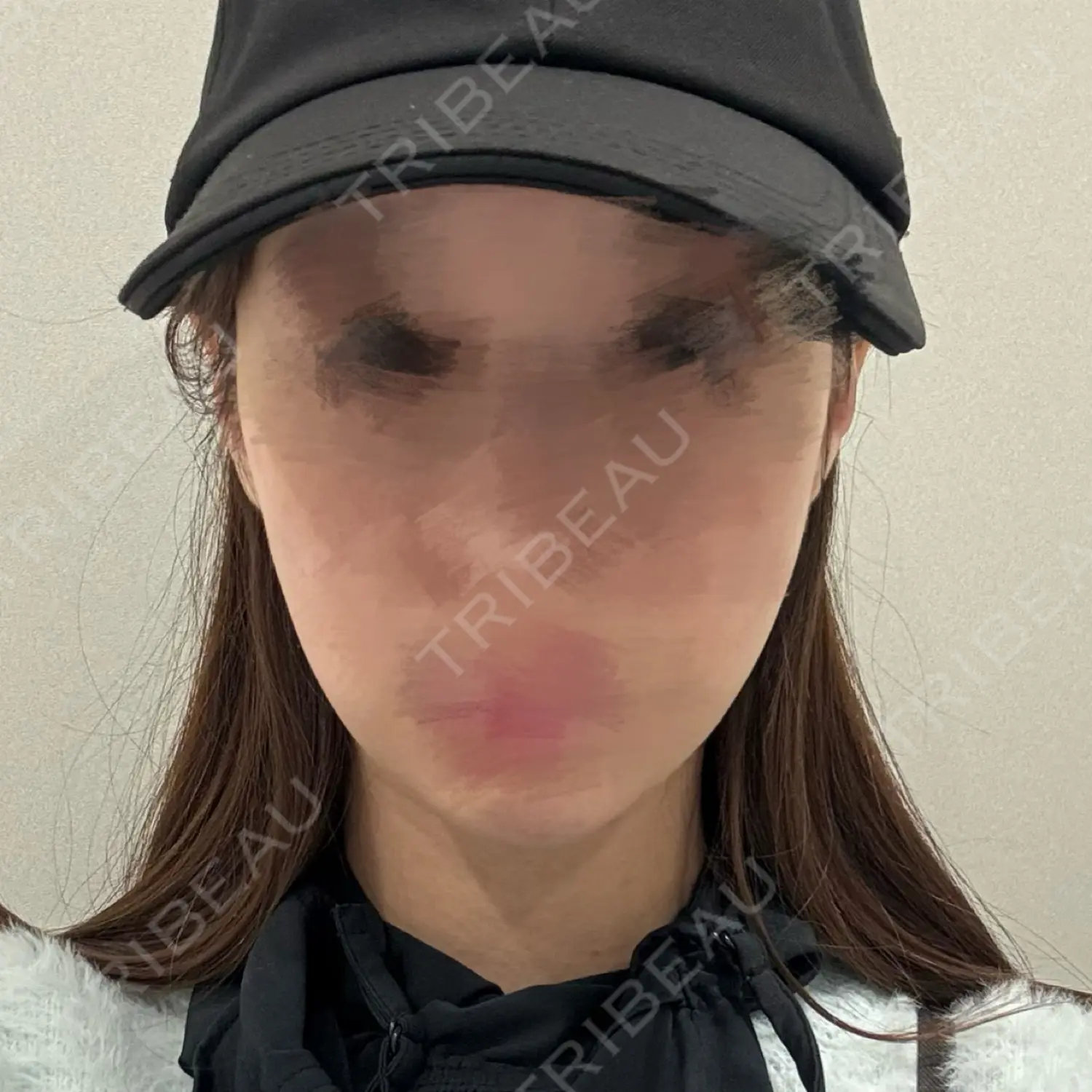 施術前の写真