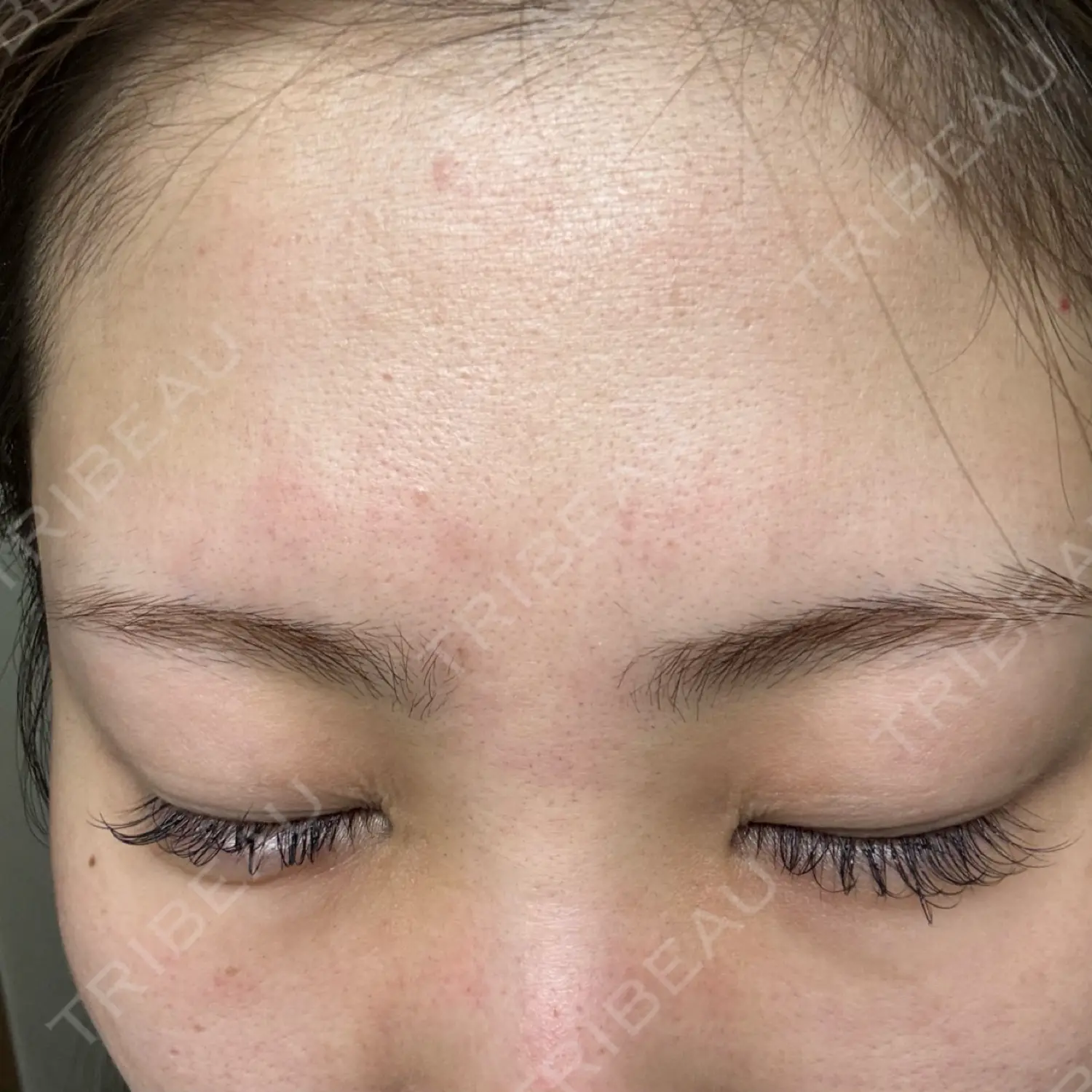 施術前の写真