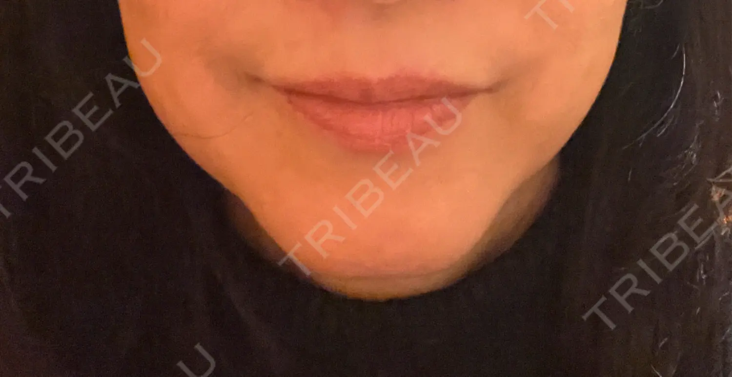 施術前の写真