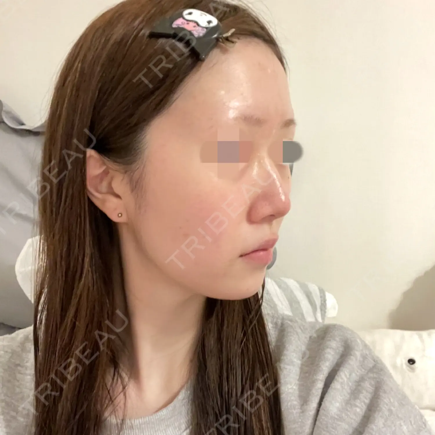 施術前の写真
