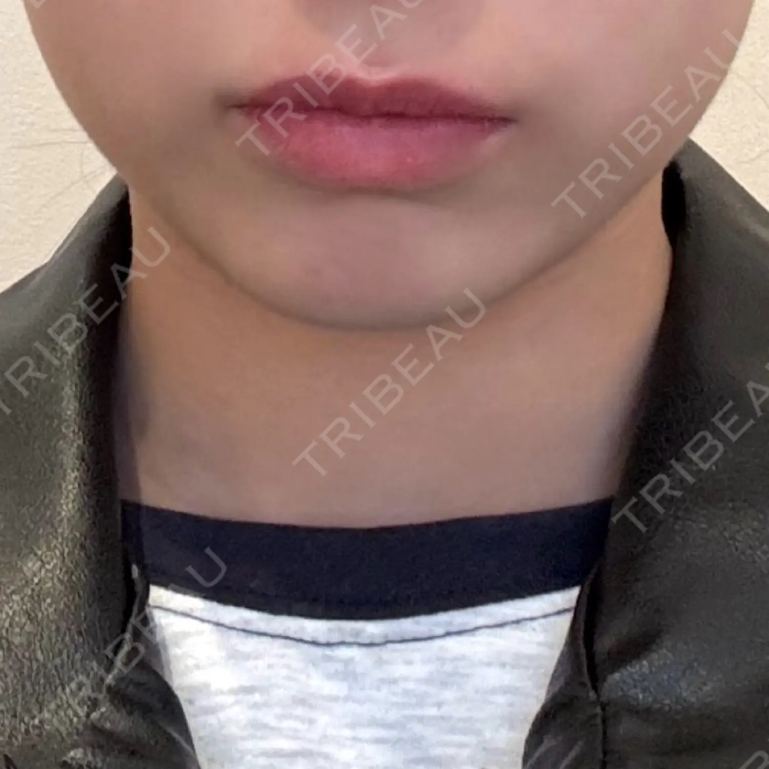 施術前の写真